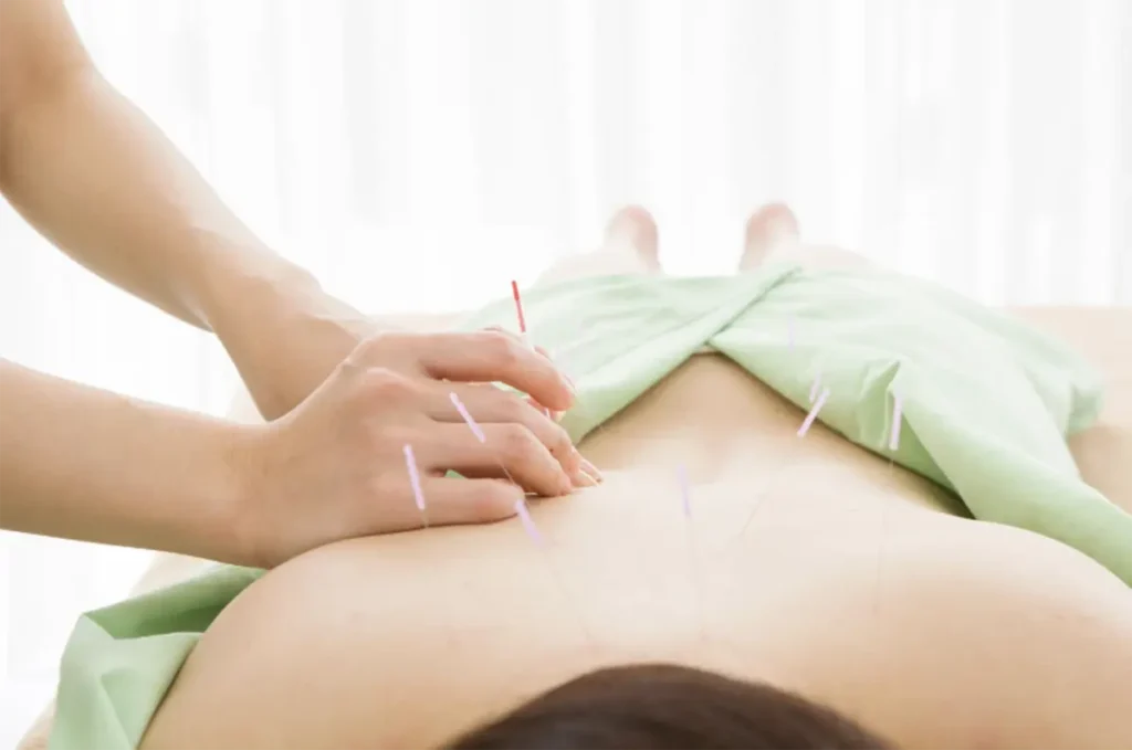woman lying on her stomach with accupuncture needles on her back